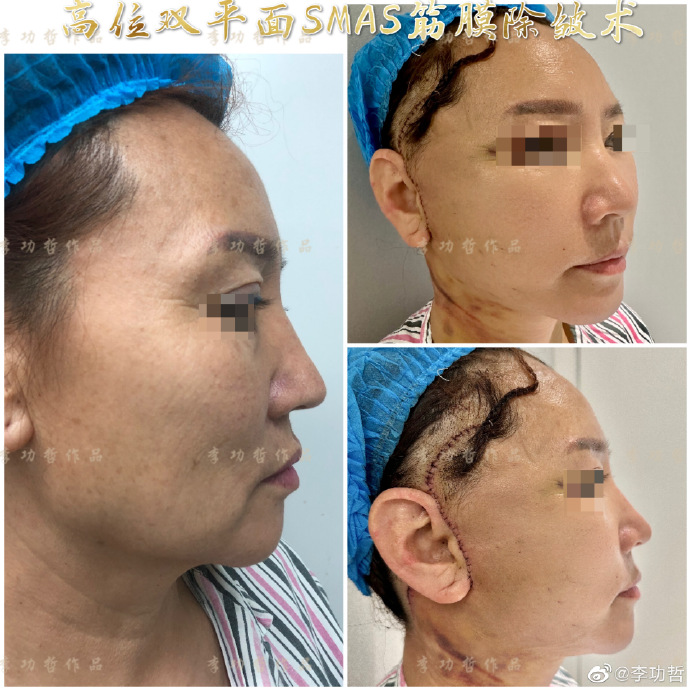 李功哲