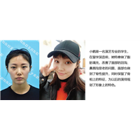 武汉脂肪填充专家