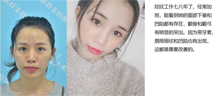 武汉脂肪填充专家