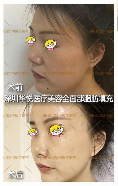 深圳肋骨鼻综合整形|深圳软肋骨鼻综合