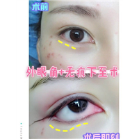深圳鼻综合哪家好|深圳眼综合哪家好