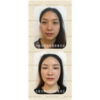 深圳华悦整形|深圳肋骨鼻综合整形