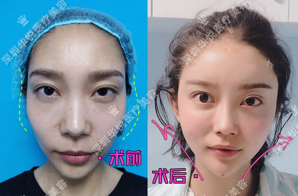 深圳华悦整形|深圳肋骨鼻综合整形