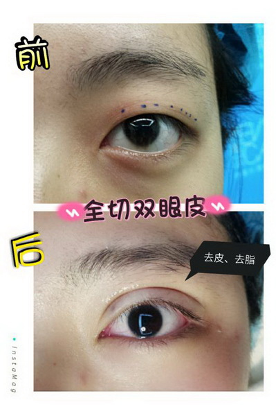 深圳眼综合整形|深圳鼻综合哪家好