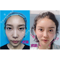 深圳华悦整形|深圳肋骨鼻综合整形