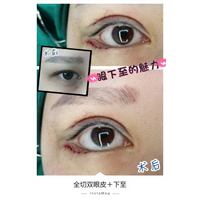 深圳眼综合整形|深圳鼻综合哪家好