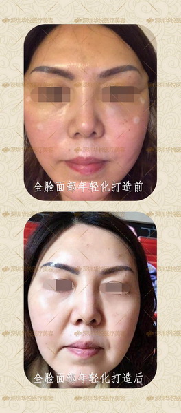 深圳肋骨鼻综合整形|深圳软肋骨鼻综合