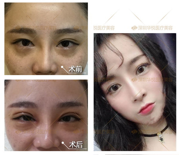 深圳软肋骨鼻综合|深圳眼综合整形