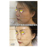 深圳肋骨鼻综合整形|深圳软肋骨鼻综合