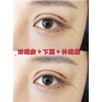 深圳软肋骨鼻综合|深圳眼综合整形
