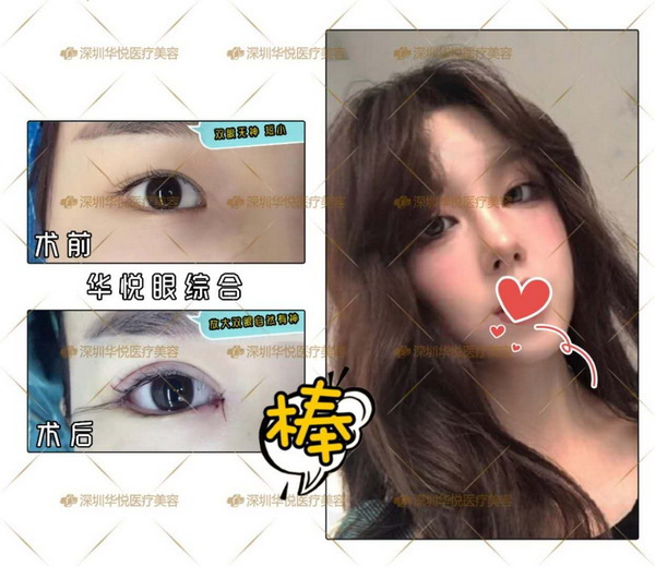 深圳眼综合哪家好|深圳华悦整形医院