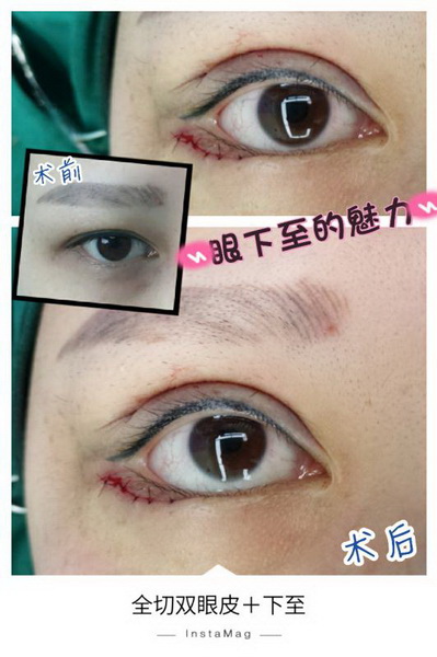 深圳眼综合整形|深圳鼻综合哪家好