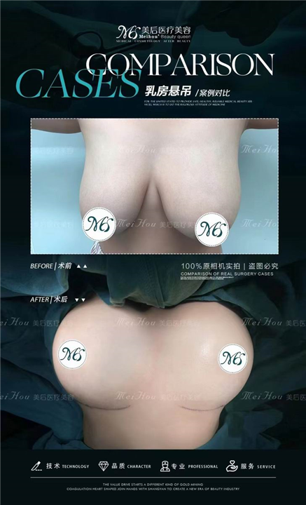 广州美后隆胸怎么样