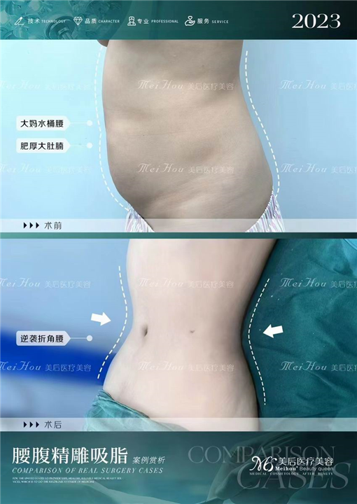 腰腹环吸手术的优点是什么？