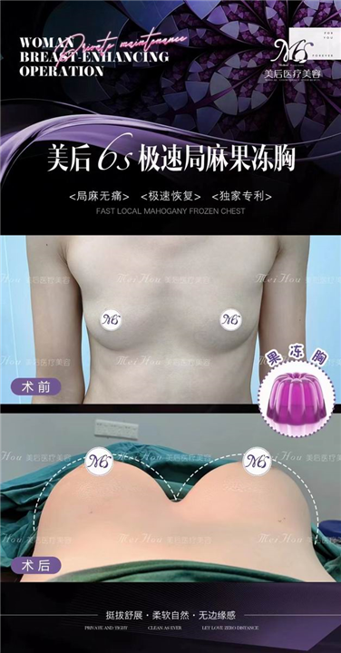 广州美后隆胸怎么样