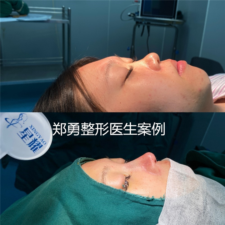 郑勇医生做鼻子怎么样