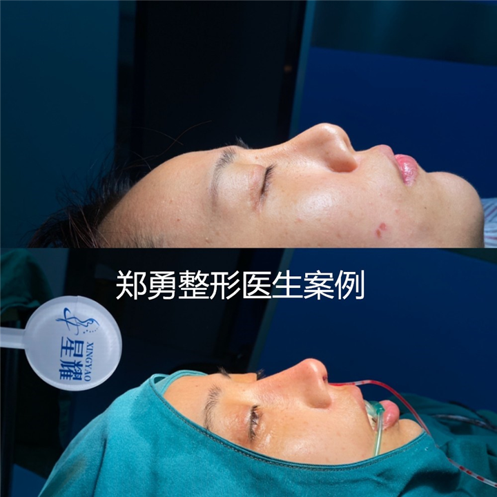 郑勇医生做鼻子怎么样