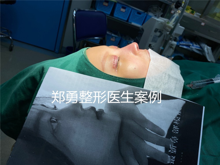 郑勇医生鼻整形案例