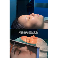 长沙缩鼻翼整形医生