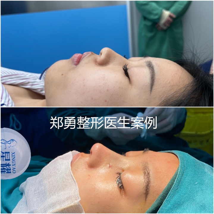 长沙郑勇做鼻子怎么样