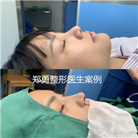 郑勇医生做鼻子怎么样