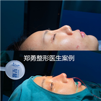 郑勇医生做鼻子怎么样
