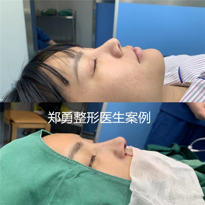 长沙郑勇鼻整形修复