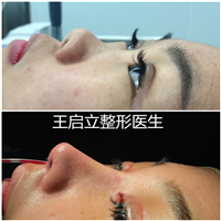 王启立鼻整形