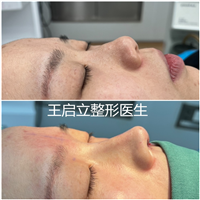 王启立做鼻子怎么样