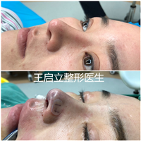 郑州鼻整形医生