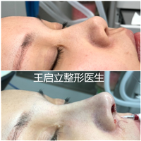 王启立做鼻子怎么样