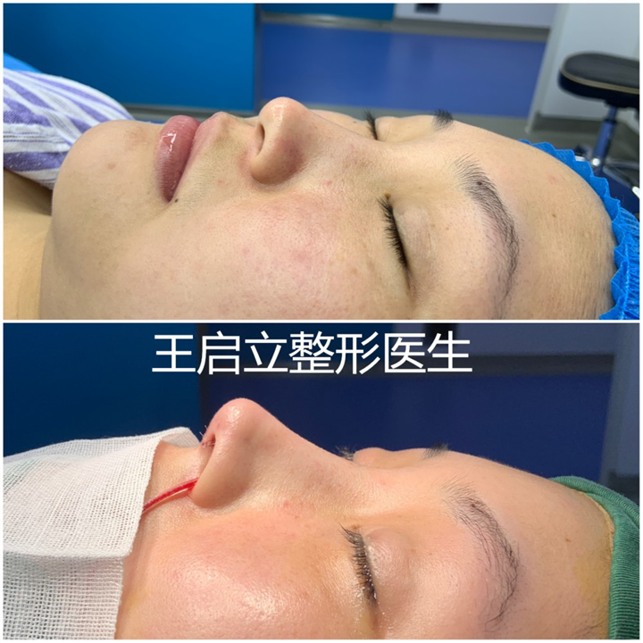 王启立做鼻子怎么样？