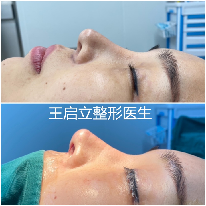 郑州王启立医生|鼻整形中需要注意哪些细节把控？