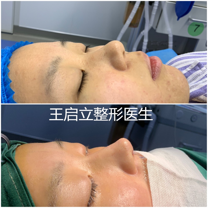 王启立医生谈隆鼻手术中鼻山根怎么做才能自然好看？