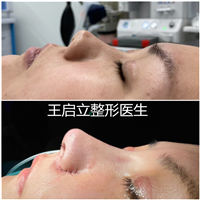 王启立鼻整形