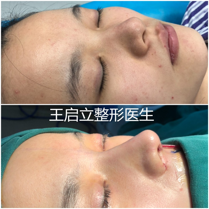 王启立鼻整形