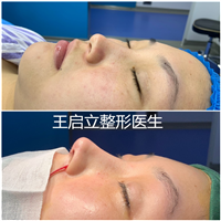 王启立做鼻子怎么样？