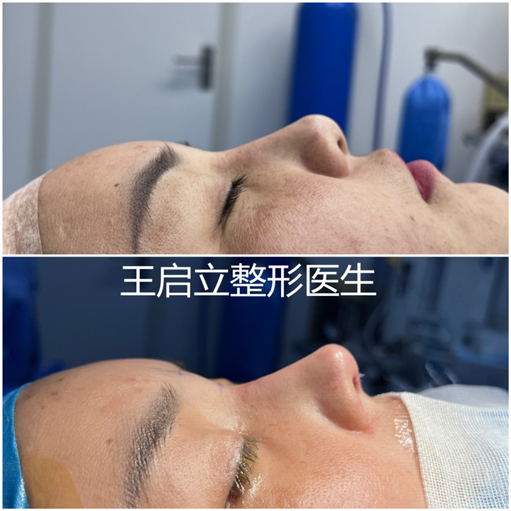 郑州鼻整形医生