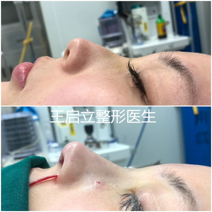河南隆鼻整形医生