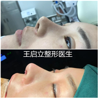 河南鼻整形医生