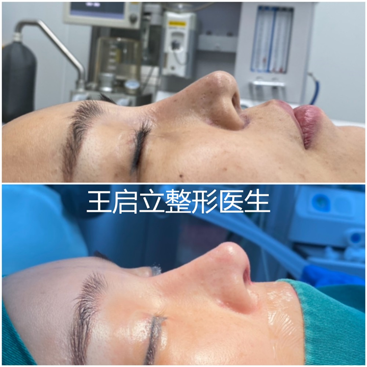 河南鼻整形医生