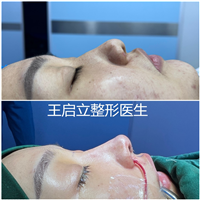 郑州鼻整形医生