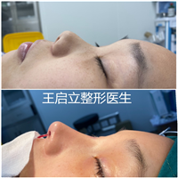 王启立鼻整形