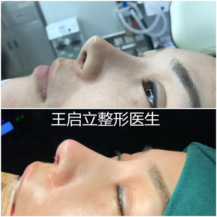 河南鼻整形医生