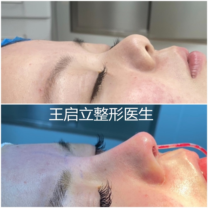郑州做高难度鼻修复王启立医生鼻整形手术后的护理