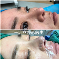 河南隆鼻整形医生
