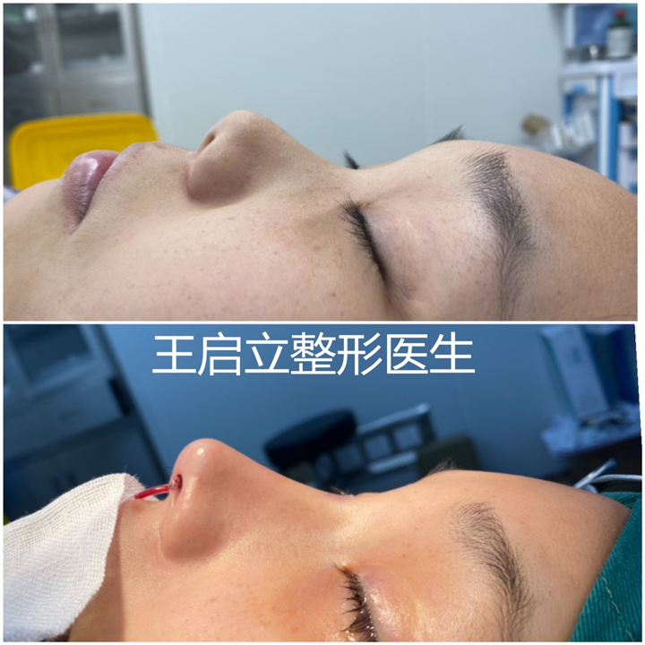 王启立鼻整形