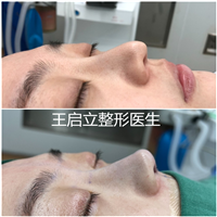 王启立做鼻子怎么样