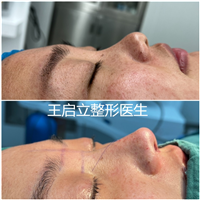 王启立做鼻子怎么样