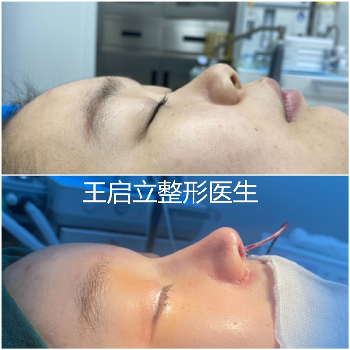 郑州王启立整形医生科普隆鼻后鼻子挛缩应如何修复？